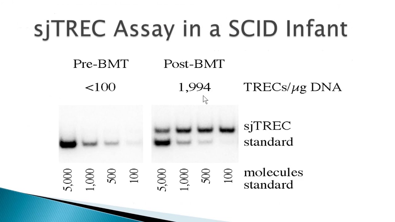 Newborn Screening: SCID, Related T-cell Lymphocyte Deficiencies and Beyond