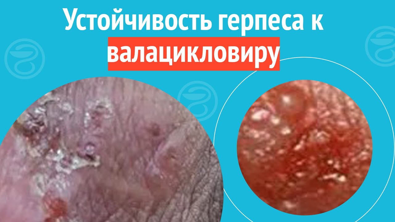 😕 Устойчивость герпеса к валацикловиру. Клинический случай №1184