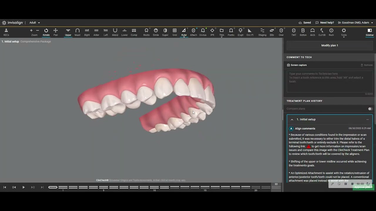 Very common mistake with clincheck design in Invisalign treatment- unrealistic root torque