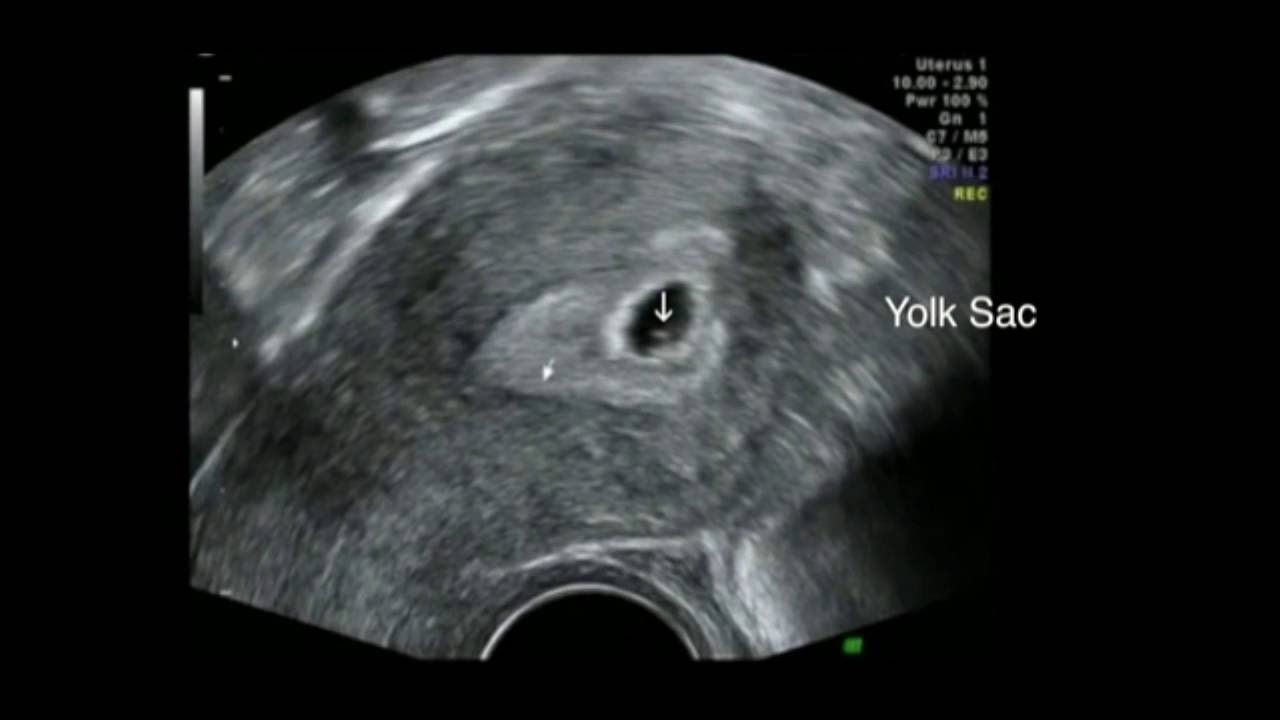 Ultrasound 5 Weeks Gestation |Early pregnancy scan |