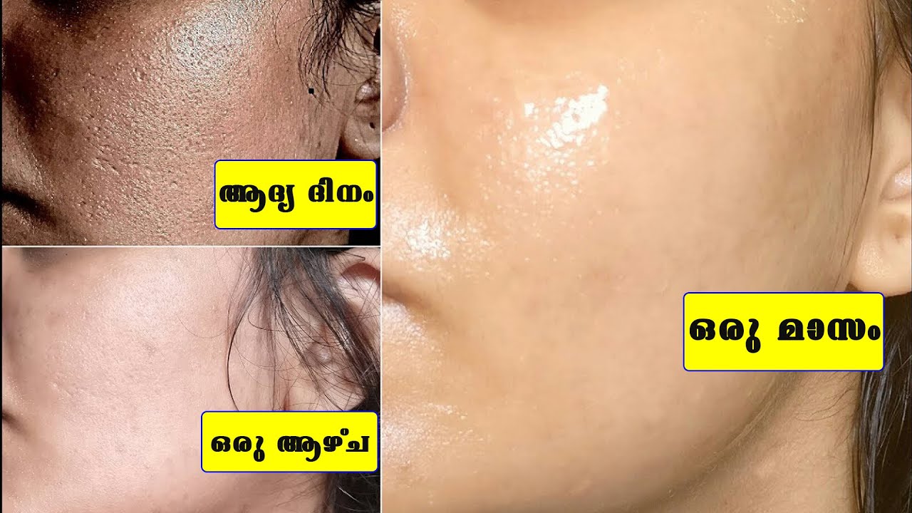 ഇതല്‍പ്പം മുഖതിട്ടു മുഖം കഴുകിയാല്‍ ജീവിതത്തില്‍ കുരുക്കളും പാടുകളും വരില്ല /Baiju's Vlogs