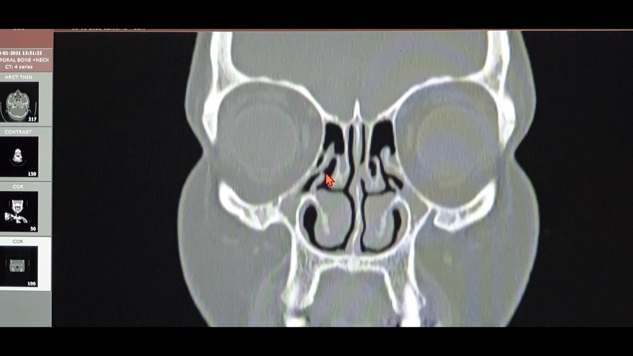 When to Operate for FESS in Chronic Bilateral Pansinusitis with Neo-osteogenesis? CT PNS Basics