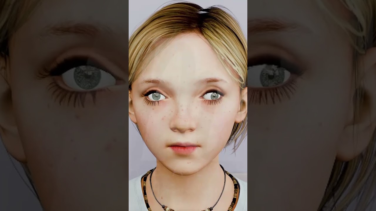 Squint Eye (Strabismus) Explained by Dr. Bhupesh Singh | Causes, Treatment & Surgery  #eyecare