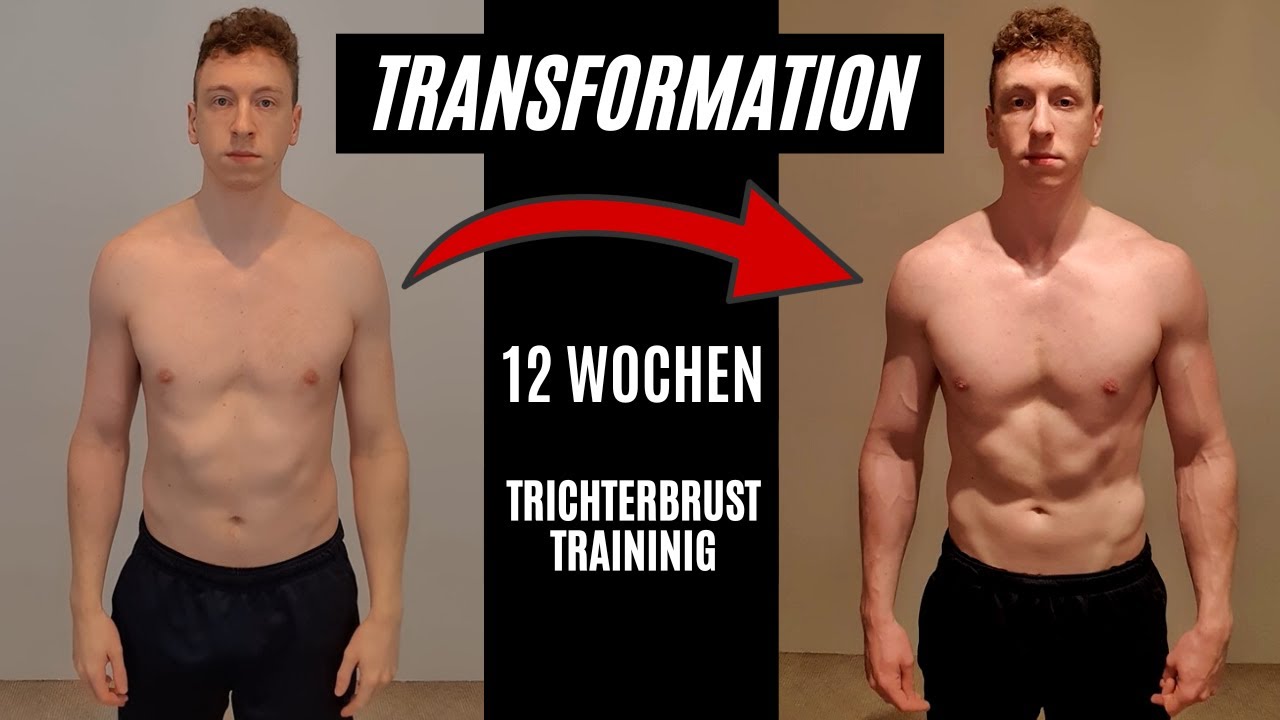 12 Wochen TRICHTERBRUST TRANSFORMATION | VORHER-NACHHER Pectus Excavatum wegtrainiert!