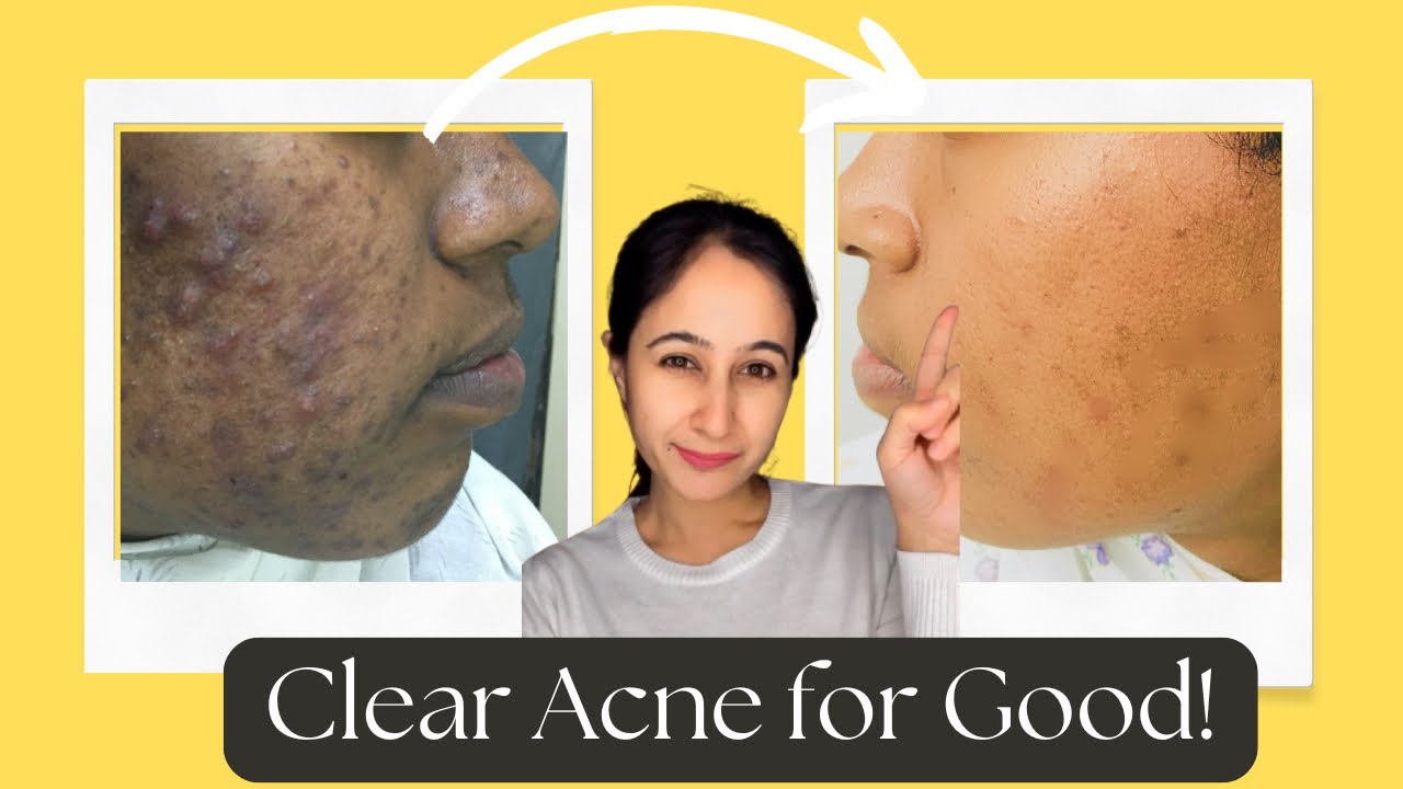 How to remove pimples from face?Blackheads/whiteheads|How to achieve clear skin|Dr Madhuri Anantwar