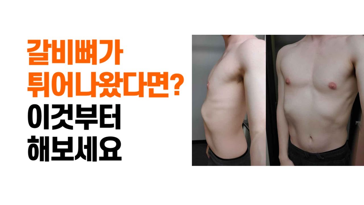 갈비뼈가 앞으로 튀어나와 있다면?