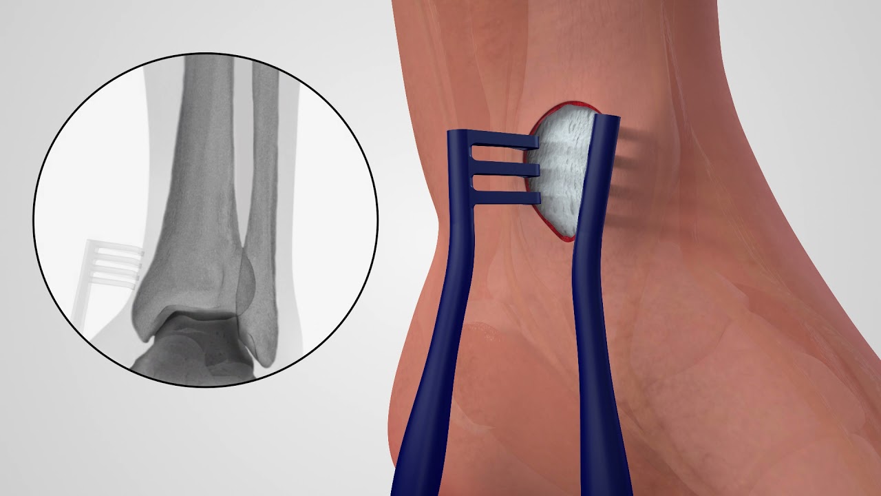 ANTHEM® Distal Tibia Fracture System