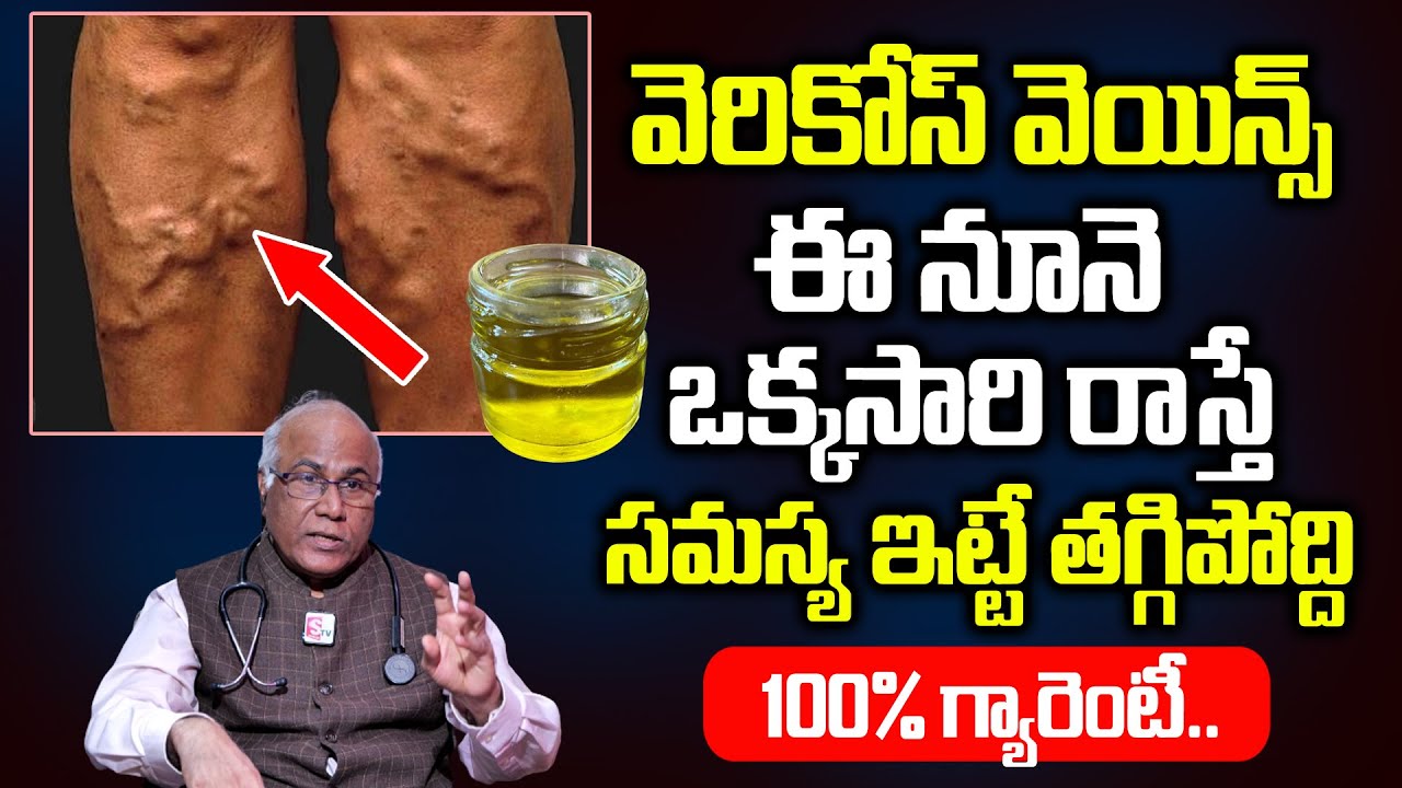 ఒక్కసారి ఇది రాస్తే వెరికోస్ వెయిన్స్ శాశ్వతంగా మాయం | Cure Varicose Veins Permanently | PlayEven