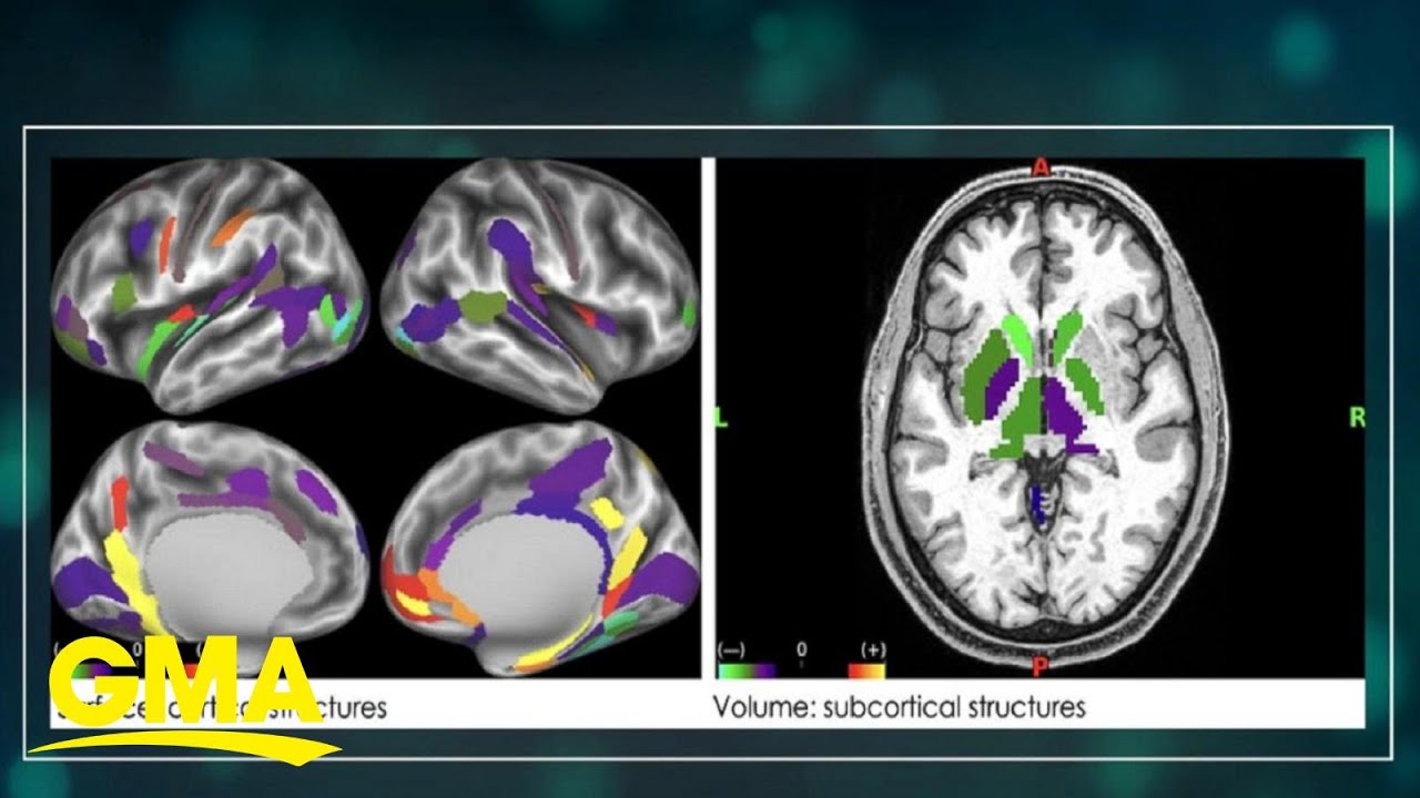 A look at our correspondent&rsquo;s brain on sugar