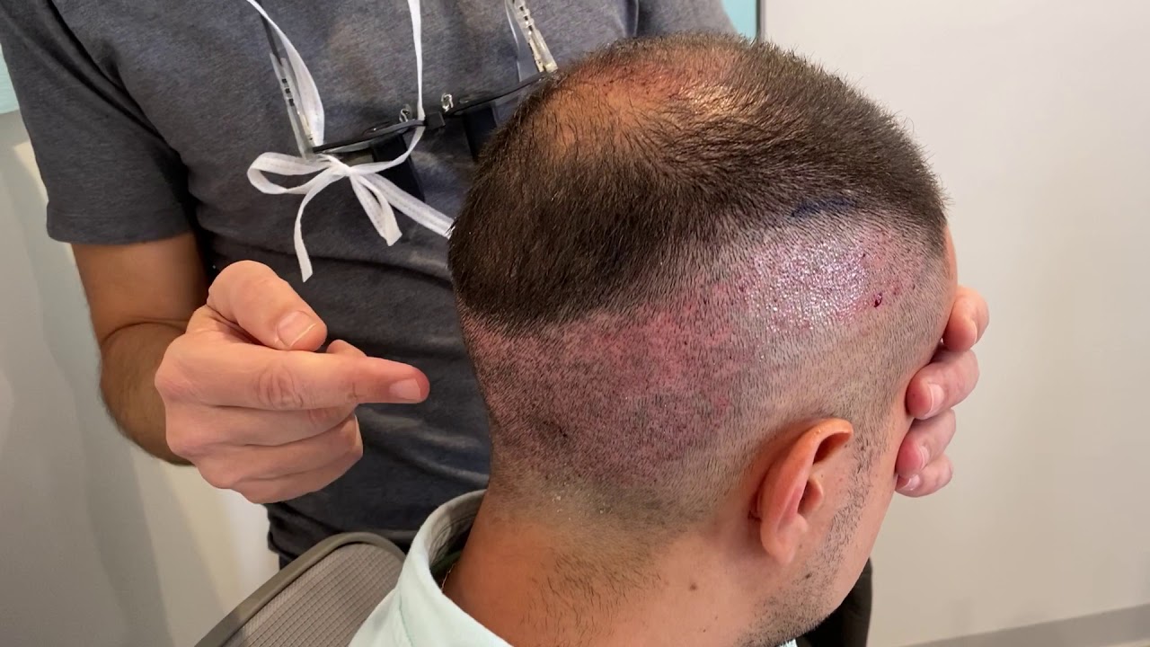 Dr. Epstein with patient one day after 2200 FUE grafts