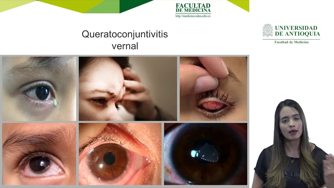 Queratoconjuntivitis alérgica - Dra. July A. Ospina