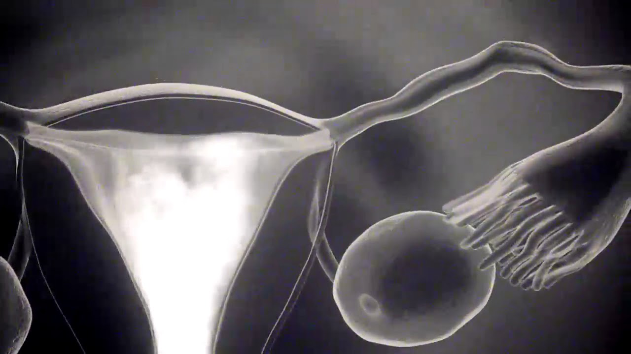Journey to Conception: Unveiling the HSG Test in Female Infertility - An Animated Guide