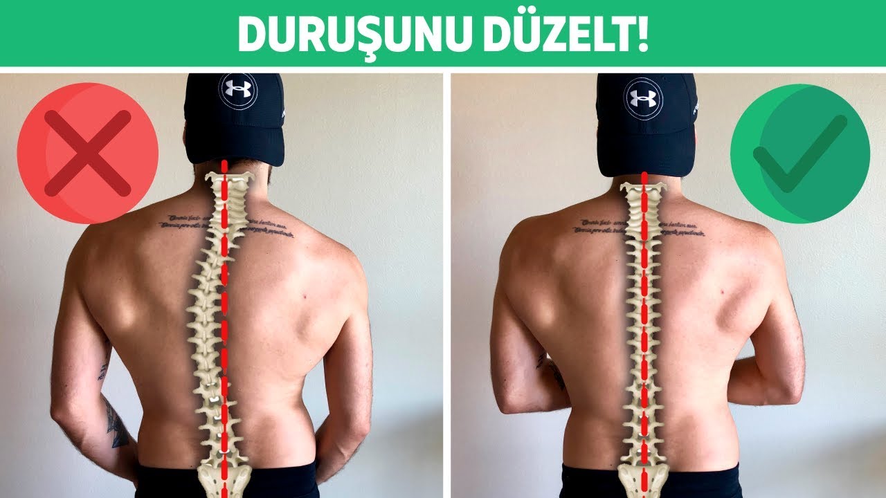 Skolyoz (Omurga Eğriliği): 3 Etkili Egzersiz | Duruşunu Düzelt
