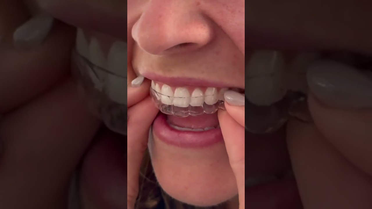 Фиксированные ретейнеры на верхних зубах 🦷 #брекеты #ретейнеры #ортодонт