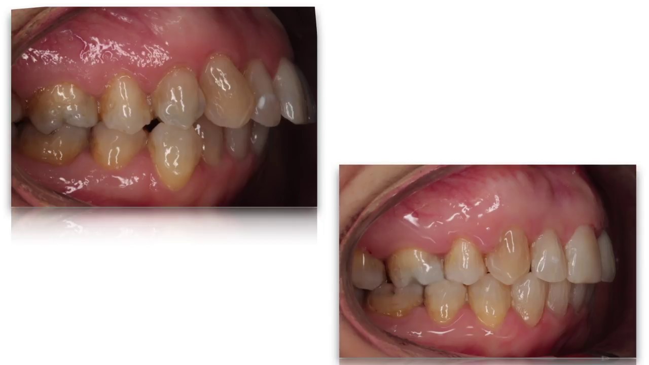 Ortodoncia dientes adelantados: Clase 2 con extracciones