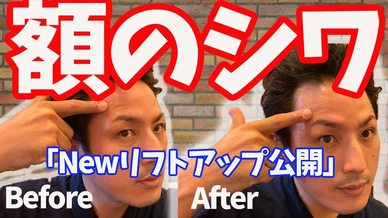 【初公開】額のシワ・リフトアップに効く「前頭筋リリース」「頭皮リリース」【大分市 腰痛治療家 GENRYU ( 安部元隆 )】