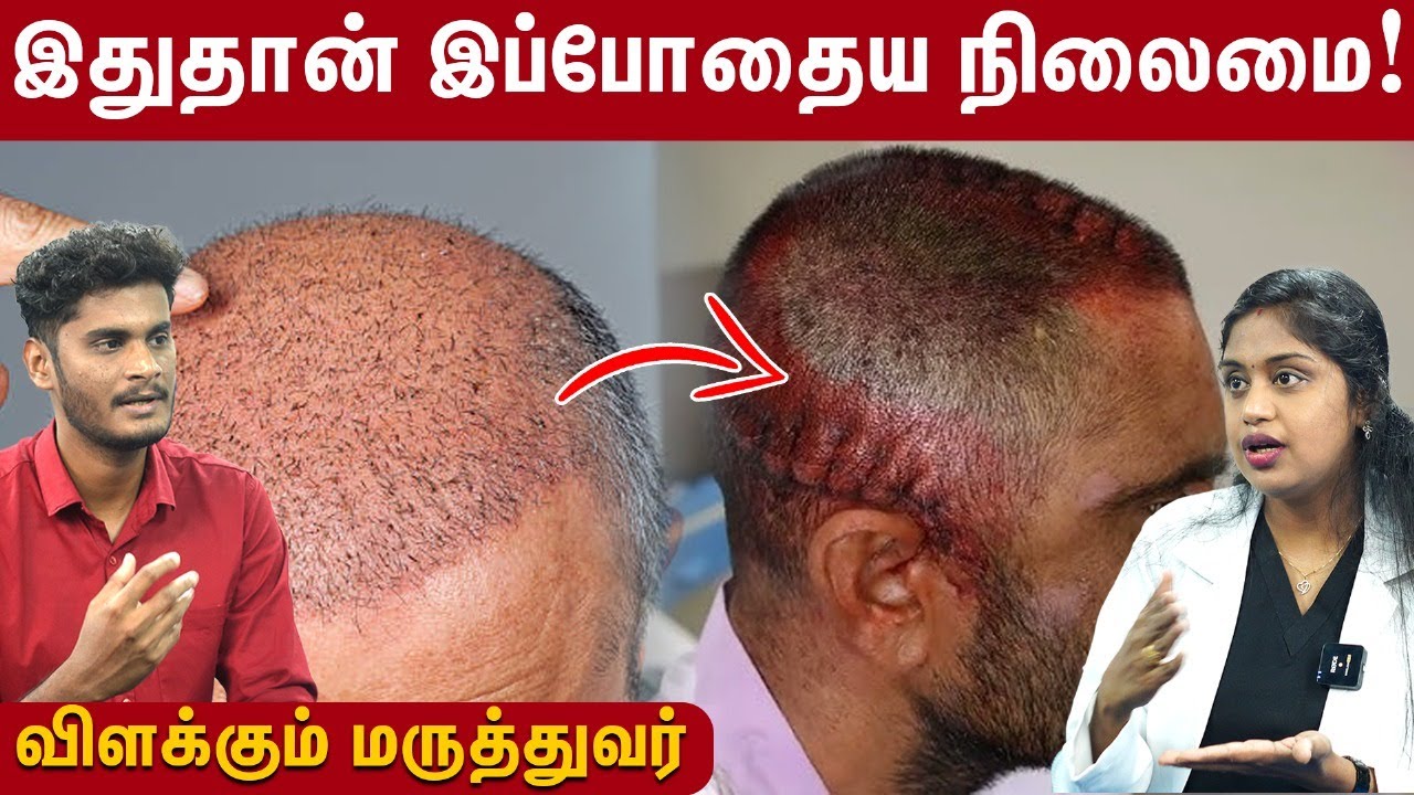 Hair transplant - உண்மைகளும் உருட்டுகளும் | Hair Transplant EXPOSED | VCare Clinic
