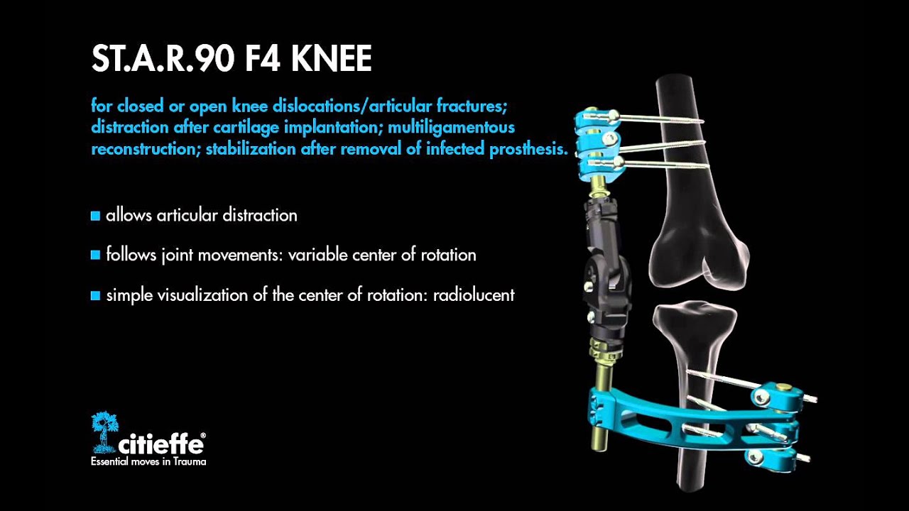 Citieffe - Articulated External Fixator ST.A.R.90 F4 KNEE (Trauma and Orthopaedic Surgery)