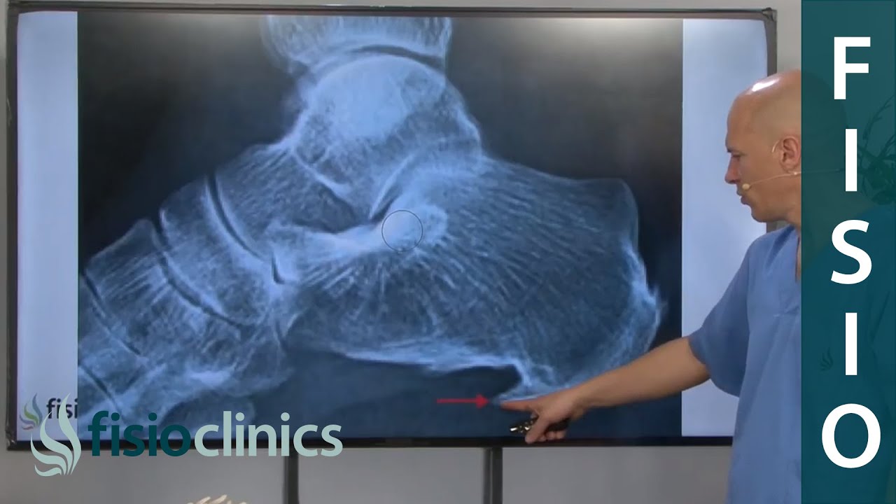 3 consejos para para curar un espolón calcáneo - FisioClinics Palma Mallorca