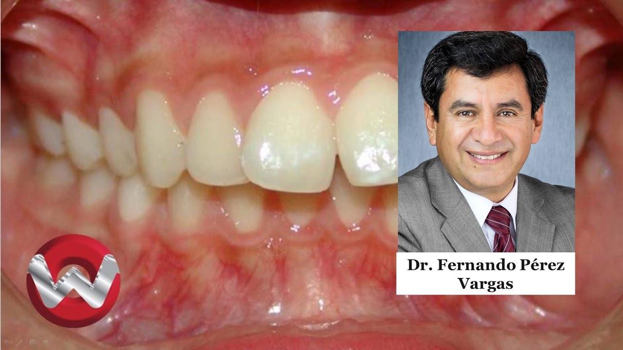 Maloclusiones dentales I