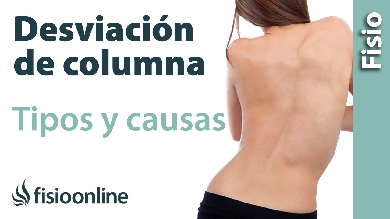 Escoliosis o desviación lateral de columna - Qué es, causas, tipos...