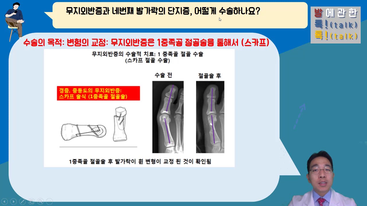 {발톡!}, 무지외반증과 동반된 네번째 발가락 단지증의 동시 수술 사례