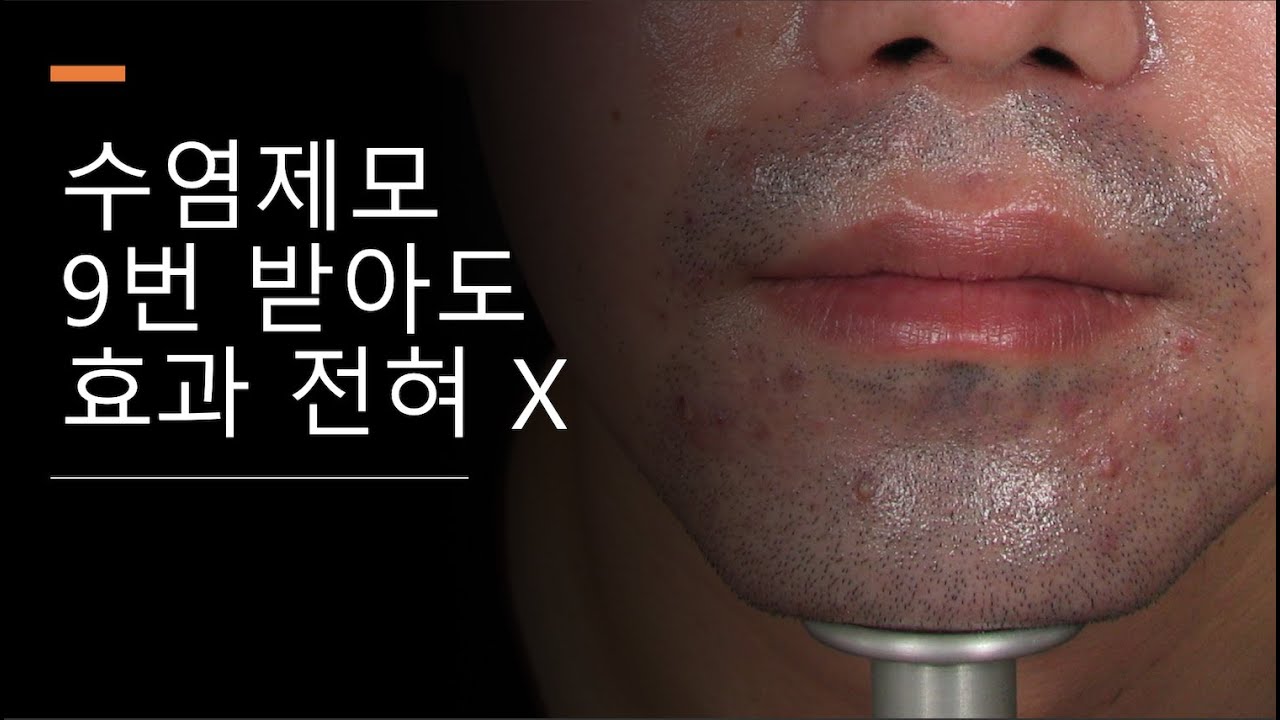 수염제모 9번 받아도 효과 전혀 X, 수염제모(Case 5)
