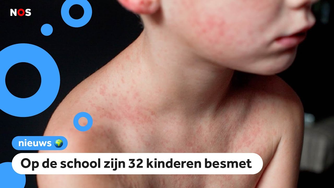 School in Rotterdam een week lang dicht door mazelen-uitbraak