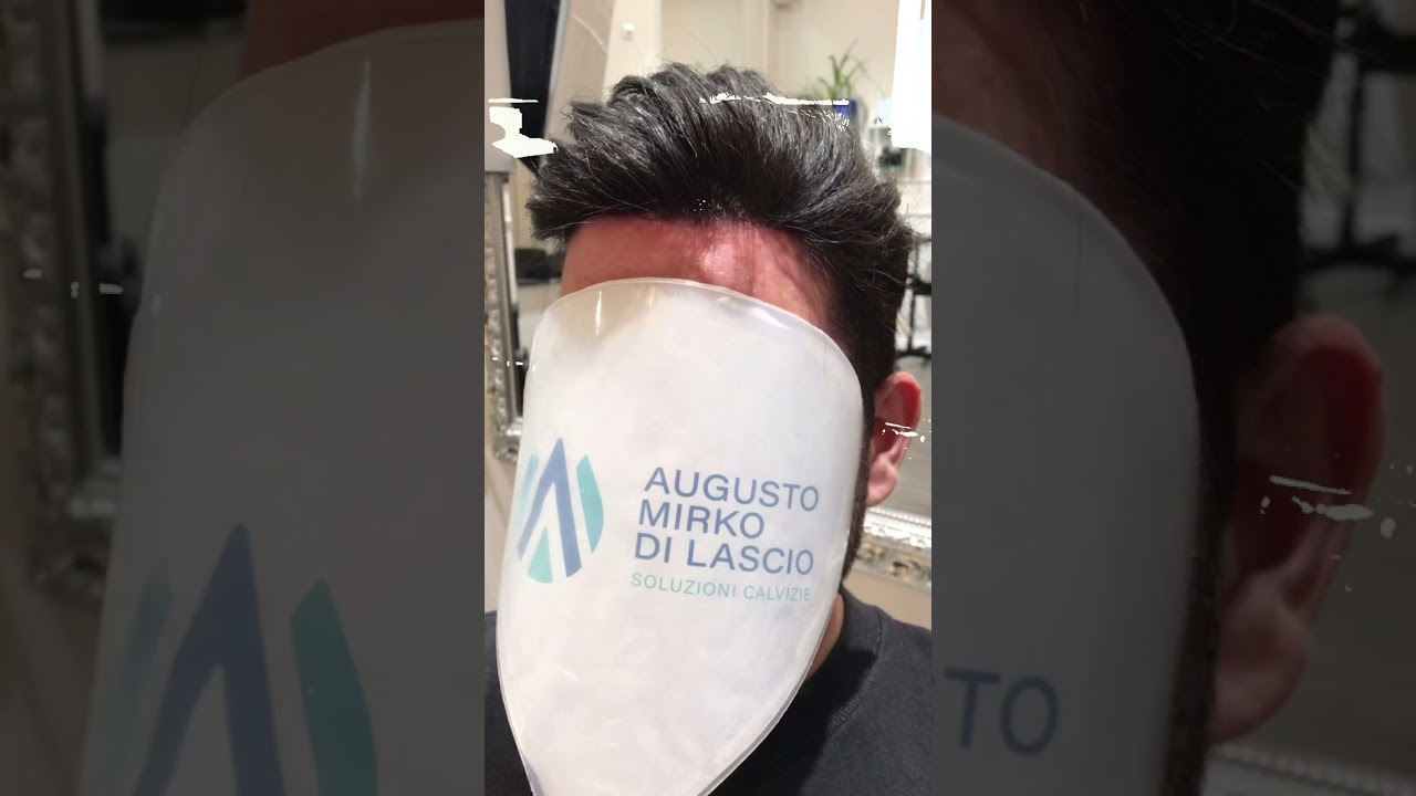 Calvizie! Indossa una Patch Cutanea di ultima generazione! 