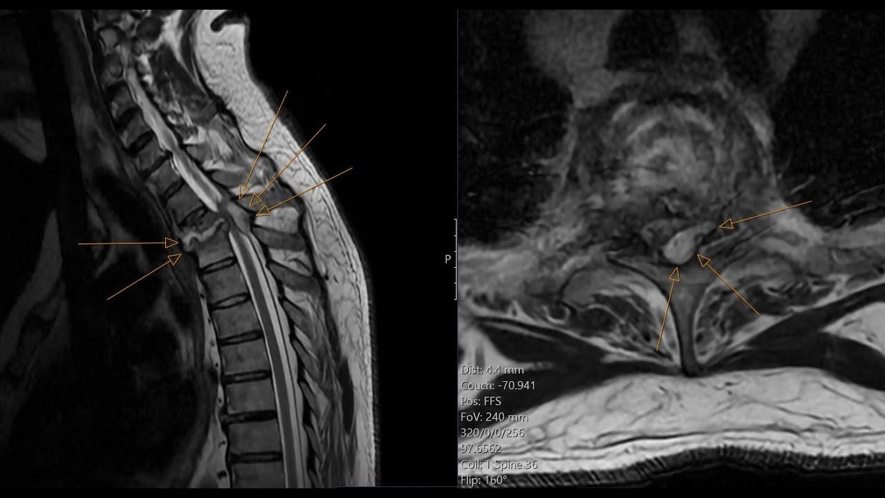 Spinal epidural abscess - spondylodiscitis - insufficiency spinal fracture. CT and MRI correlation.