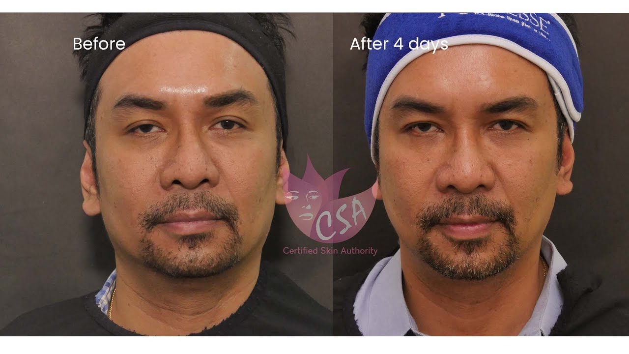 BOLD LIFT WITH RADIESSE AND HOLLOW EYES  TREATMENT WITH BELOTERO