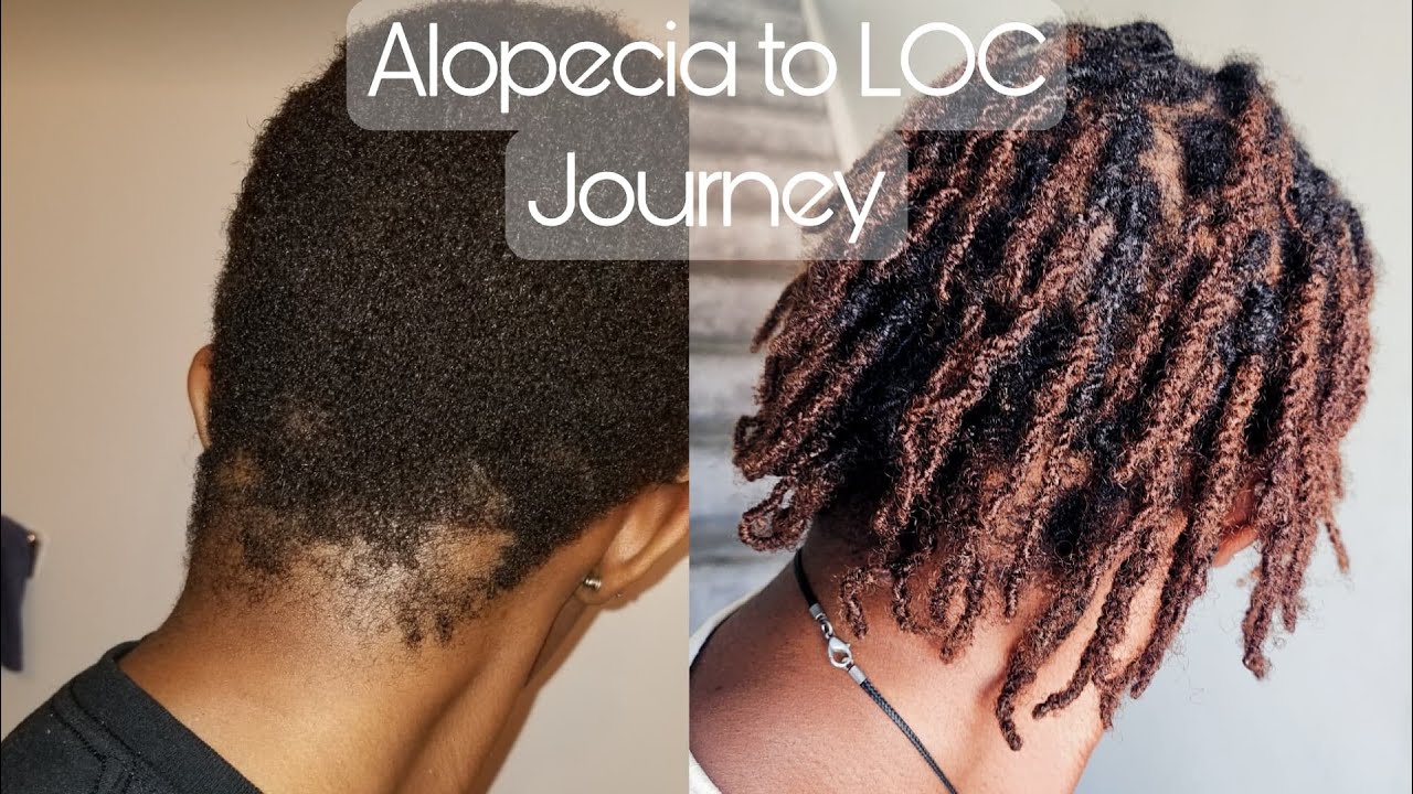 From Alopecia to locs| Get to know my journey| Pictures| thin & fine 4c hair