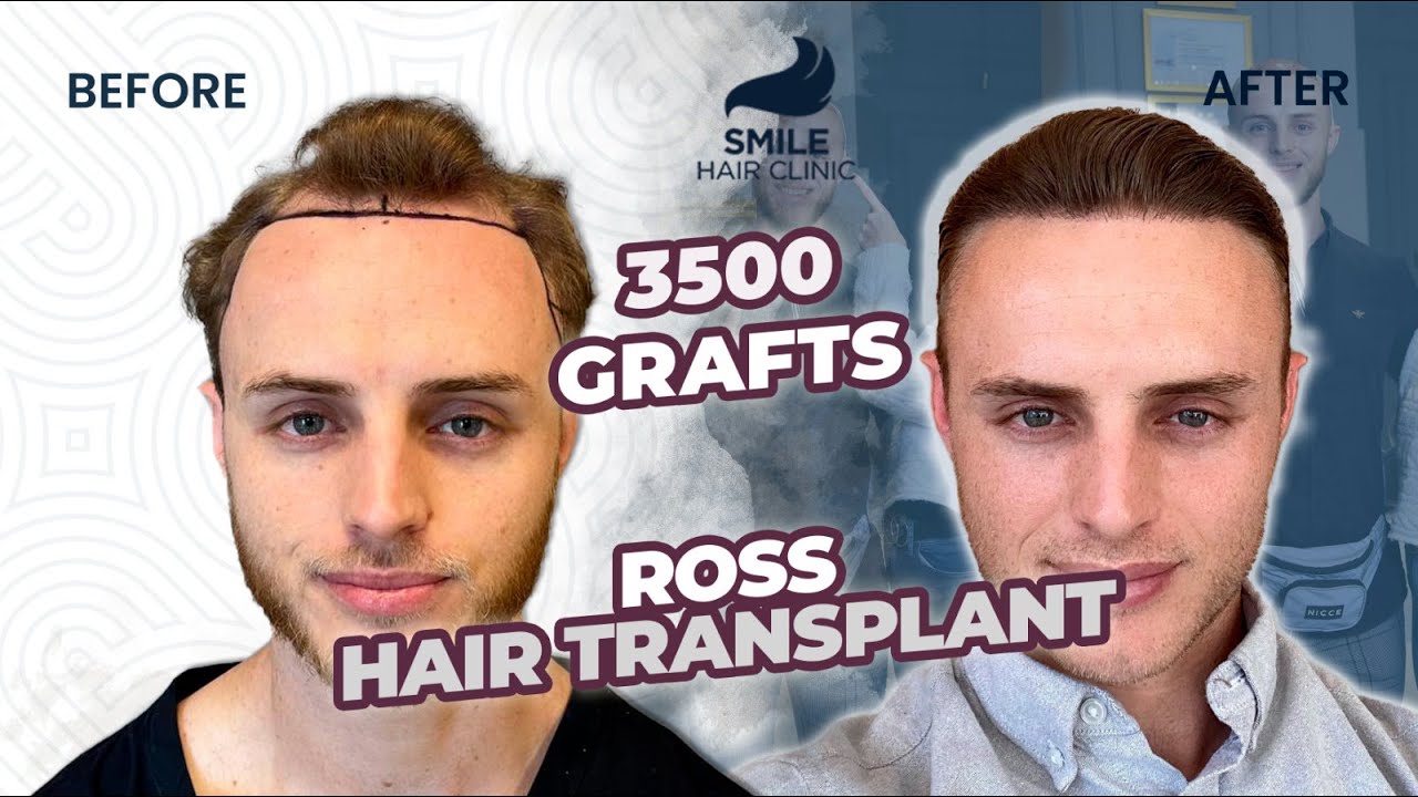 Reclaiming Confidence: Before & After - 9 Month Result | 3500 Grafts | Conquering Hair Loss!