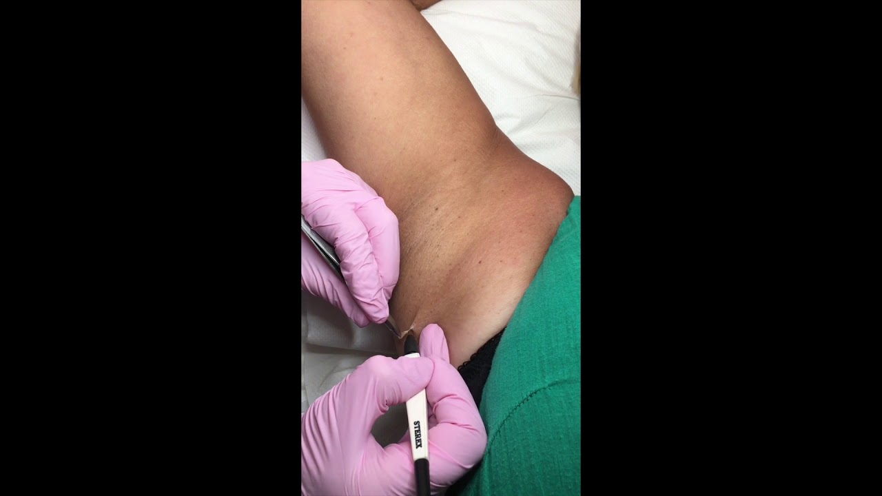 Skin Tag Removal on the Armpit | Appearances Aesthetics