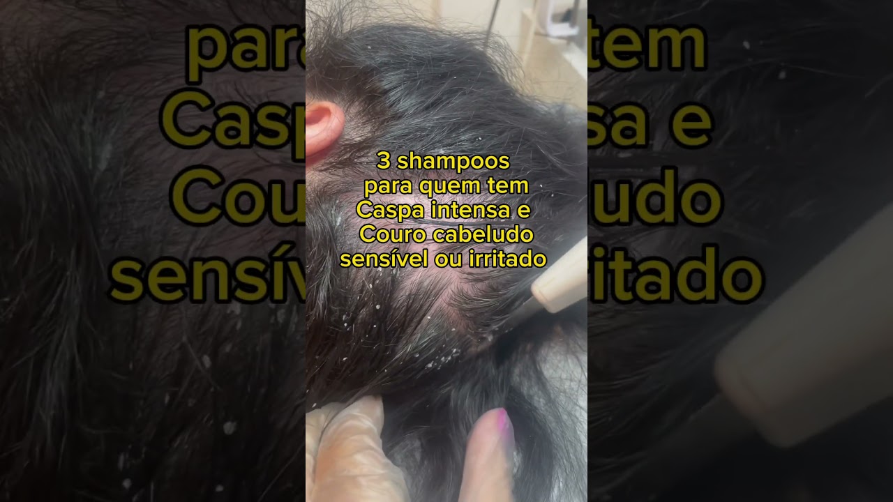 Shampoos para couro cabeludo sens&iacute;vel #dermatite #alopecia #quedadecabelo