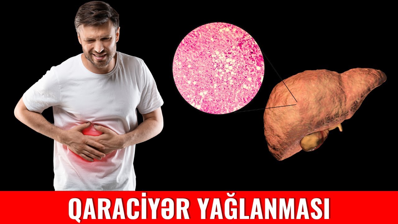 Qaraciyər yağlanmasından necə qurtula bilərik?
