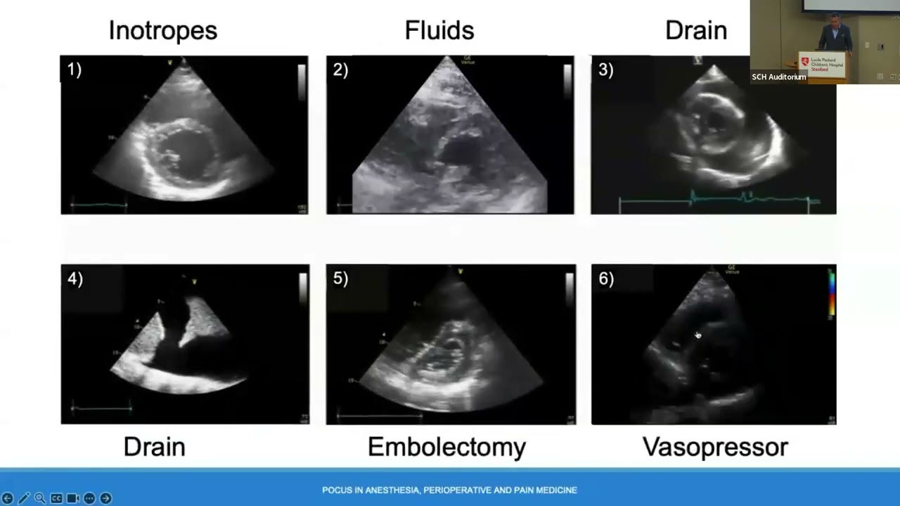 Point of Care Ultrasound in Anesthesia   Perioperative Medicine Jan Boublik MD   Marianne Chen MD 5
