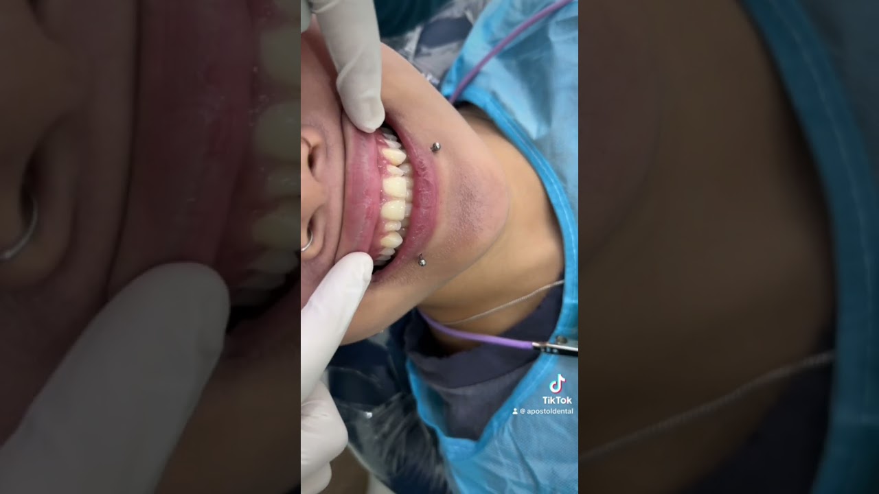 Peg Lateral Case solved with #veneers Amazing! #apostolified #dentist #smiletransformation #makeover