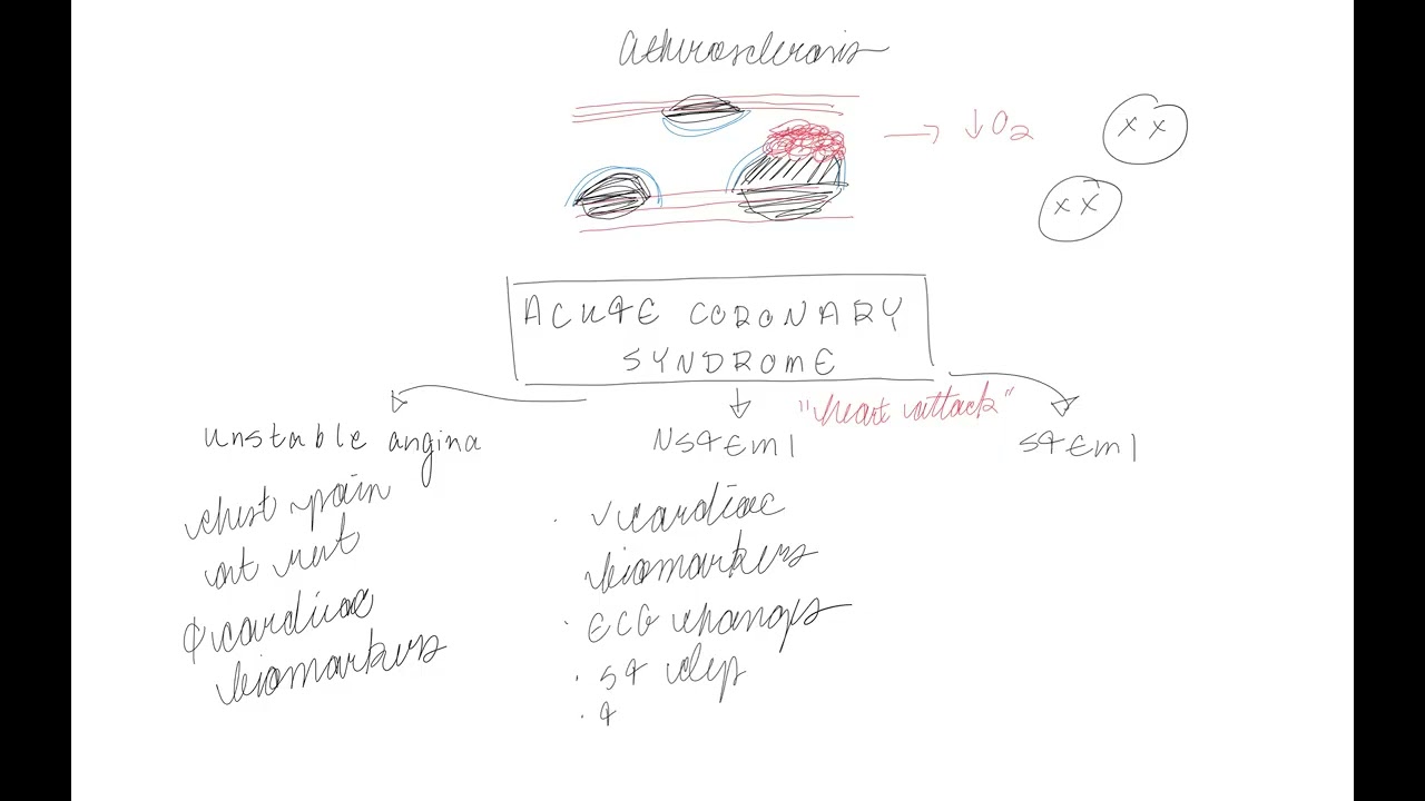 Acute Coronary Syndrome, Atherosclerosis, Stable/Unstable Angina NSTEMI, STEMI, Medications for ACS