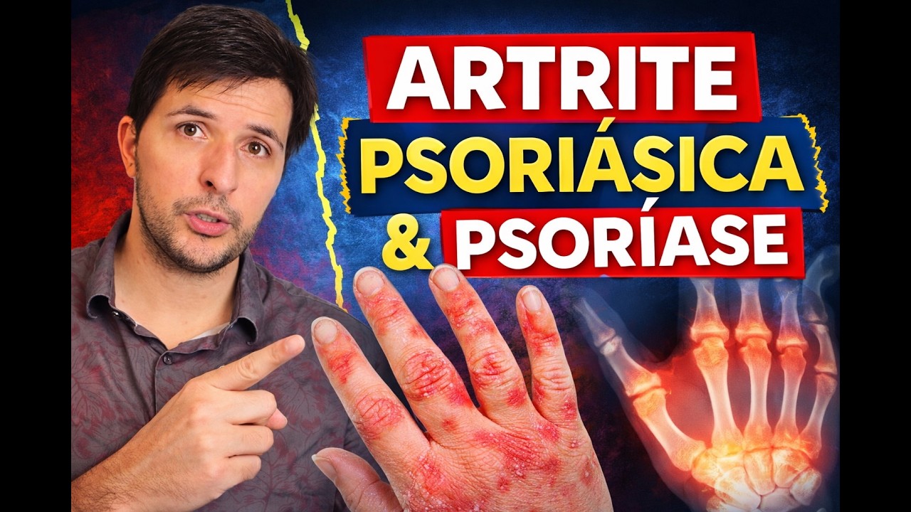Junta (#12) Psoríase e Artrite Psoriática