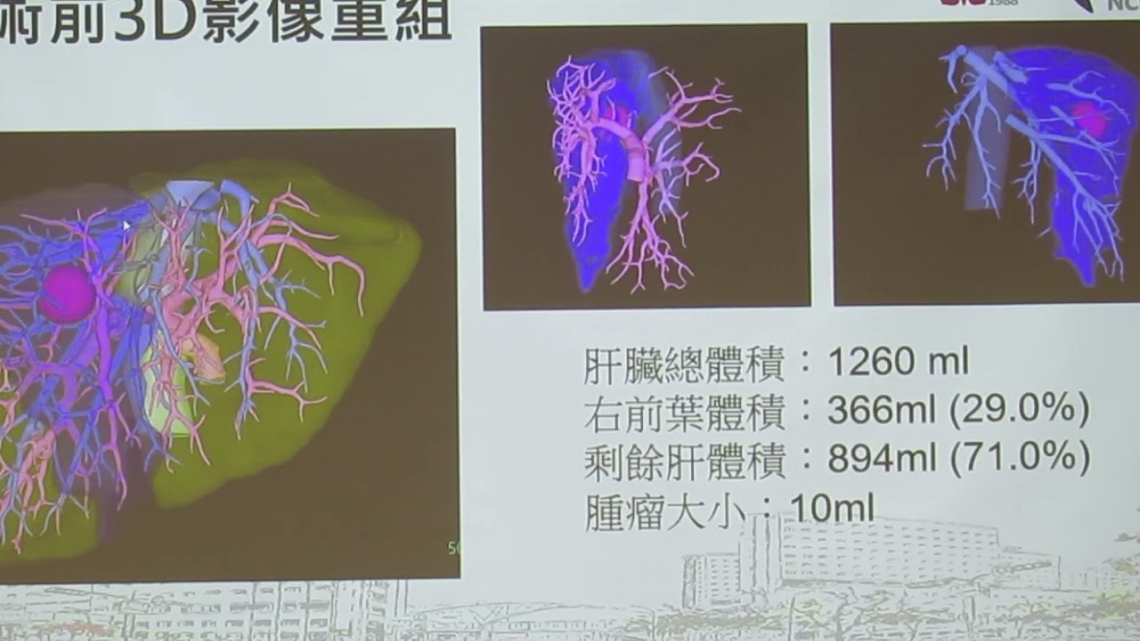 民正新聞記者:蔡永源，蔡慧茹台南報導3D影像重組結合ICG螢光導航精準肝臟手術提升肝癌根治成效