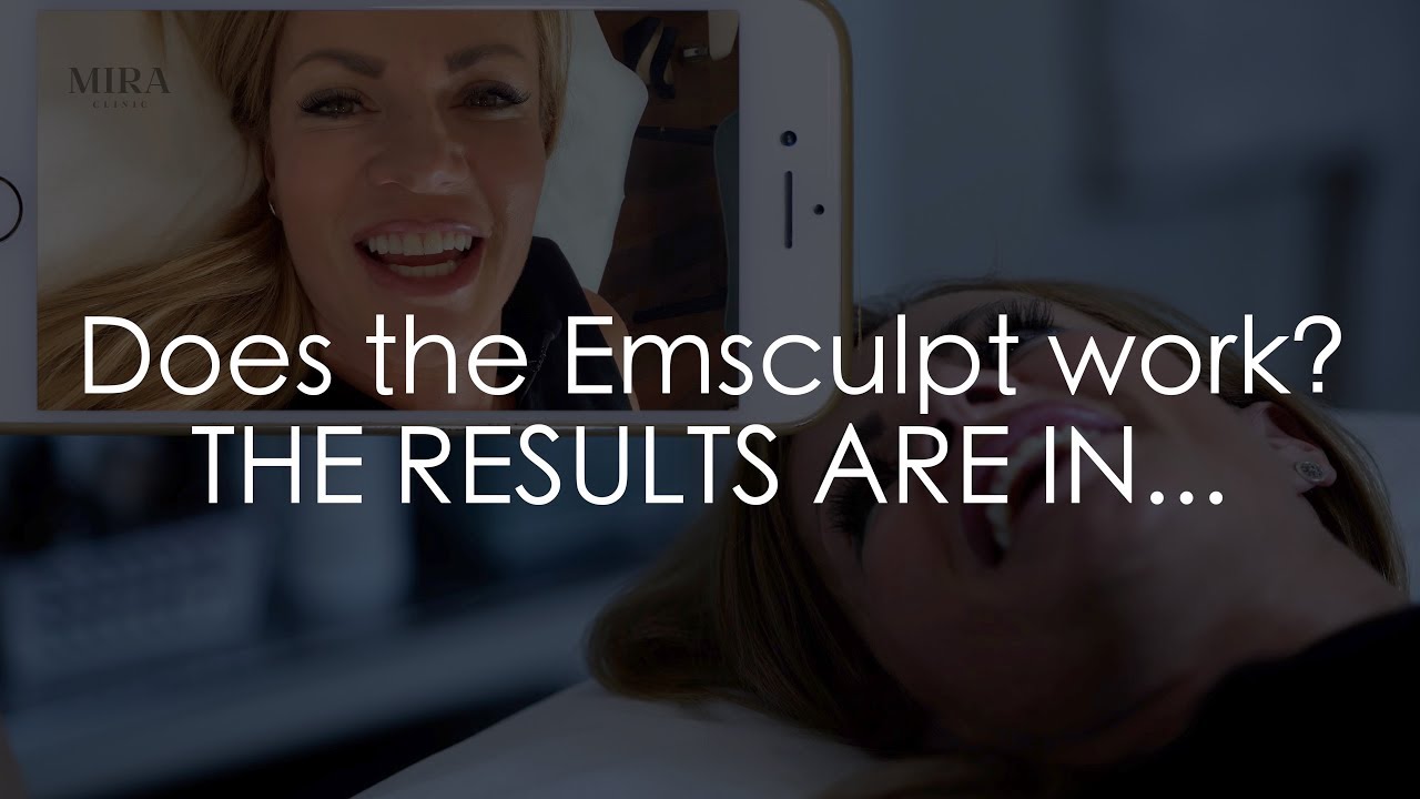 Does the Emsculpt at MIRA Clinic actually work, we see the results.