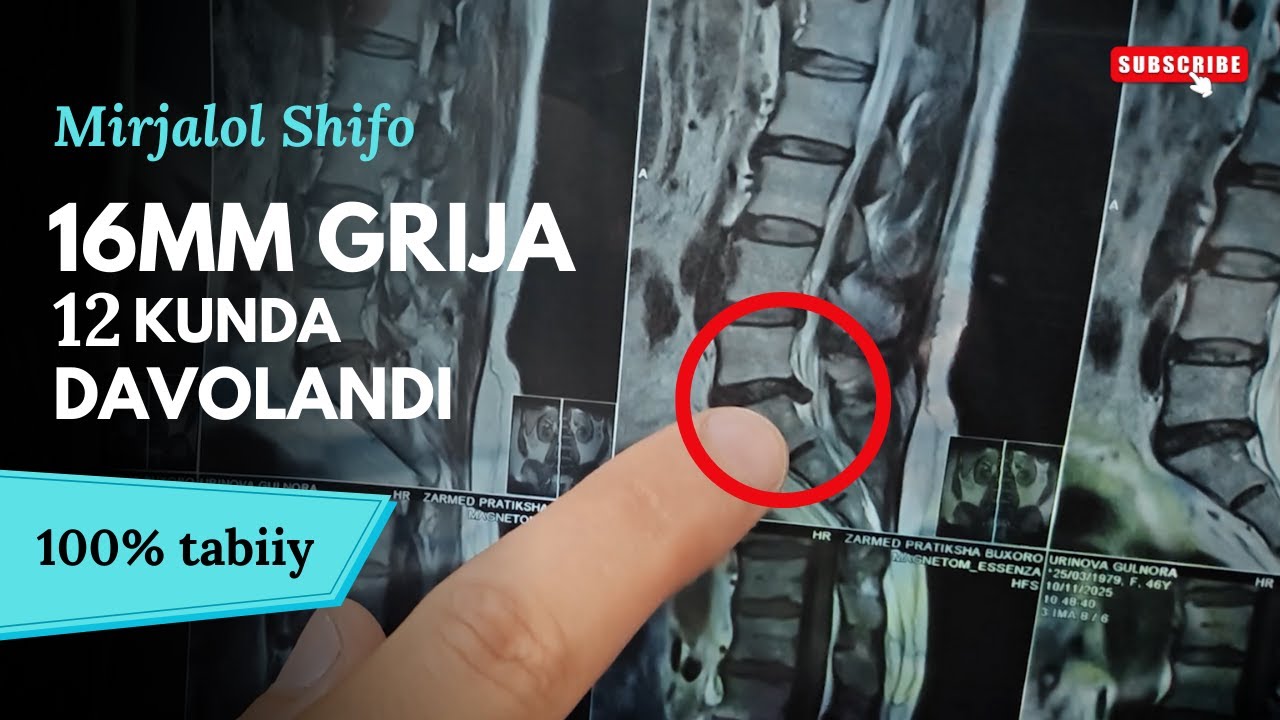 16MM GRIJA APERATSIYASIZ DAVOLANDI  #TIBBIYOT #grija