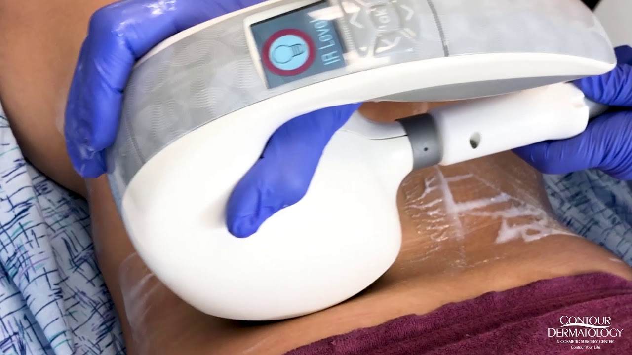 VelaShape Can Reshape and Reduce Cellulite | Contour Dermatology