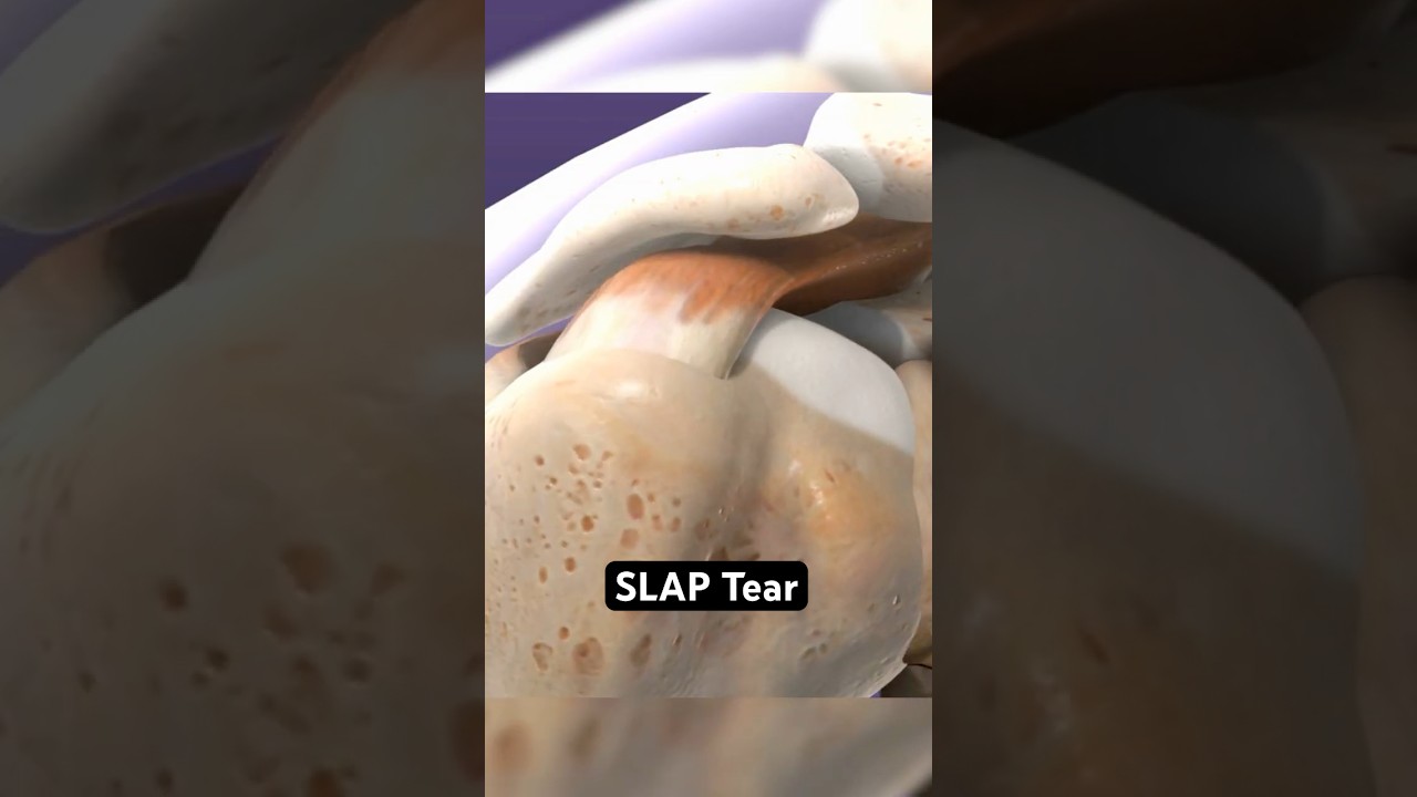 SLAP Tear: When Your Shoulder Labrum Rips