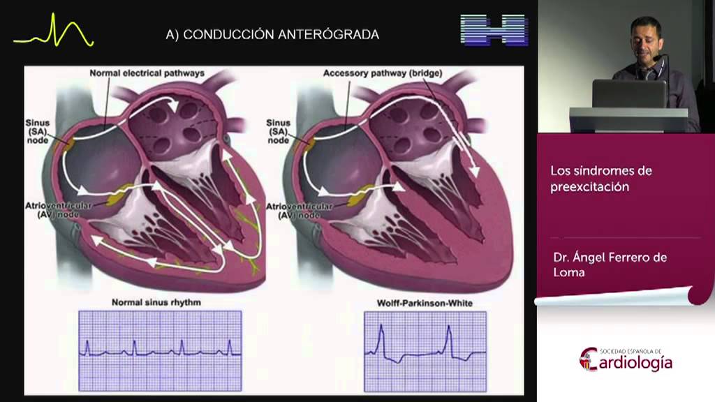 Los síndromes de preexcitación