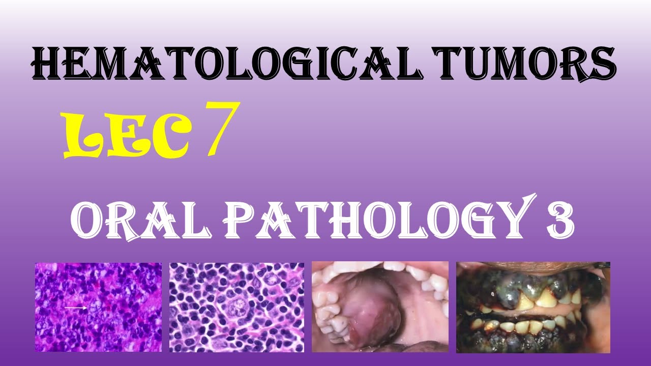 Oral Pathology 3 - Hematological tumors