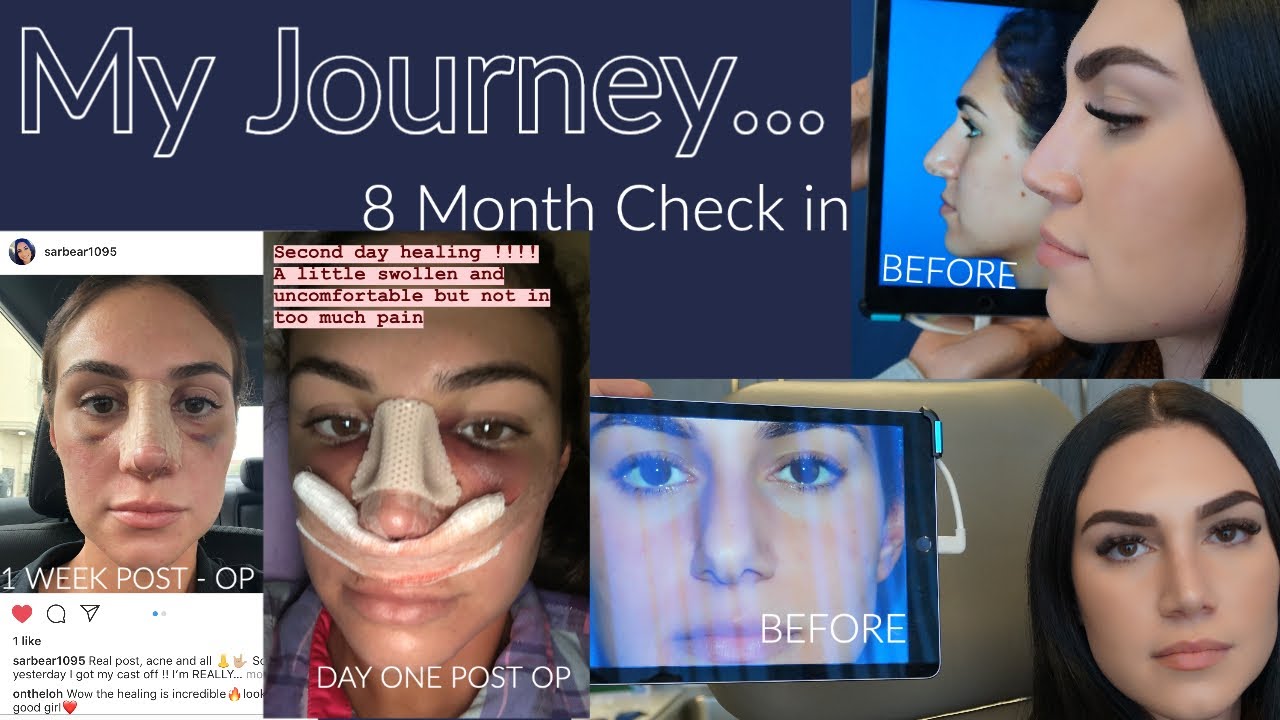 From Diamond Tip 👃🏼 to 💎 Diamond Ring 💍 👰🏻