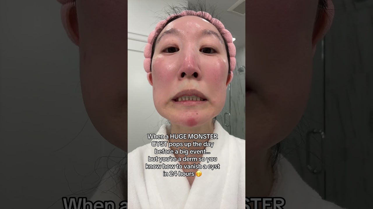A dilute shot of cortisone 💉 is magical at getting rid of an #acne cyst in 24-48 hours 💥