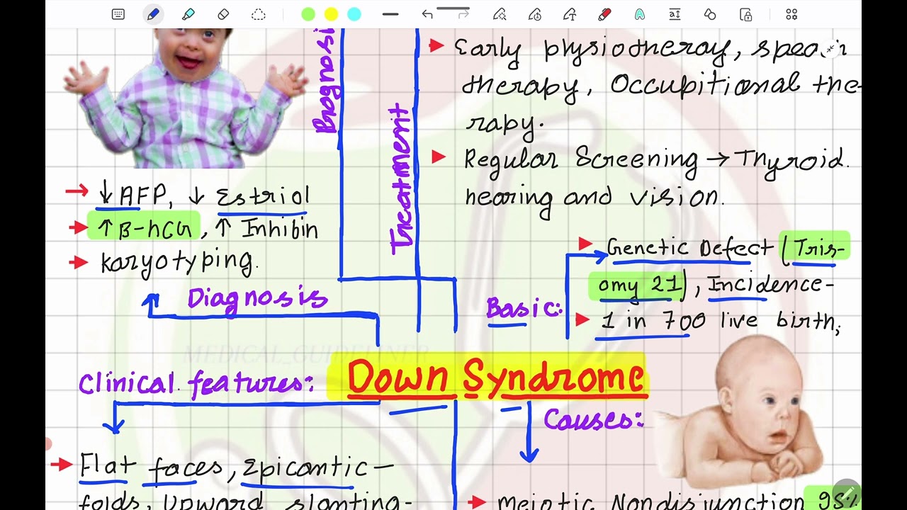 Down Syndrome Mind Map For Every Medical Student 